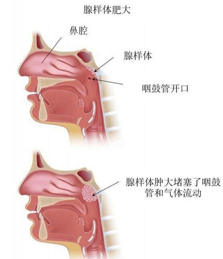 儿童腺样体知识解析及治疗方法