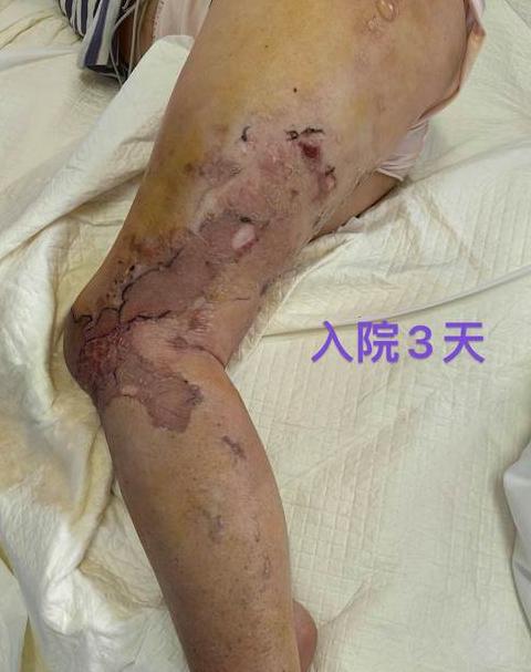 肾结石术后双J管护理要点及并发症处理