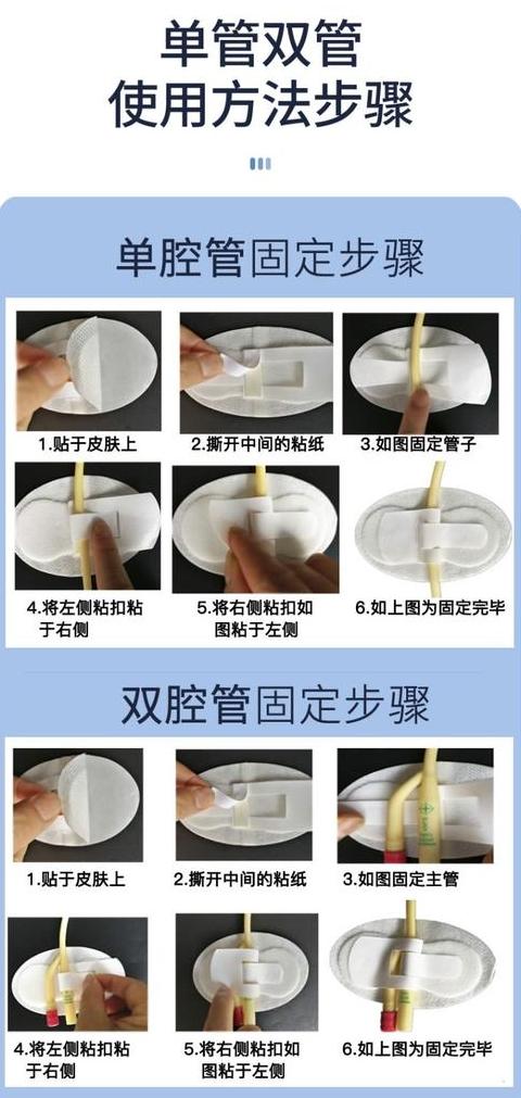 放置双J管后睡眠姿势及注意事项